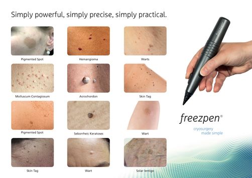 freezpen-What-can-be-treated-